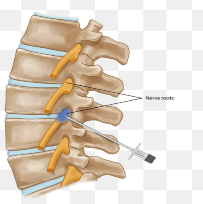 Nerve Root Block